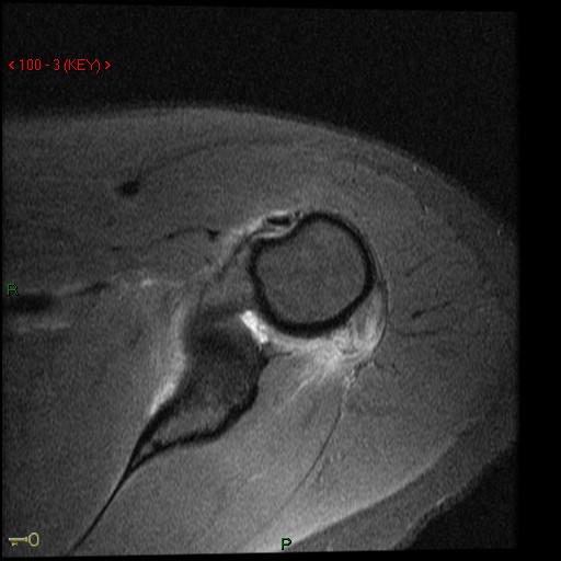 Figure 2 for case Posterior dislocation, posterior capsular avulsion from humerus   teres minor tear